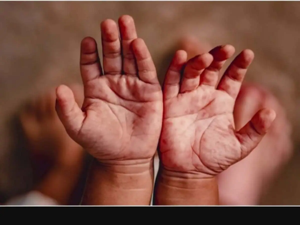 (monkeypox):