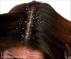 (dandruff )